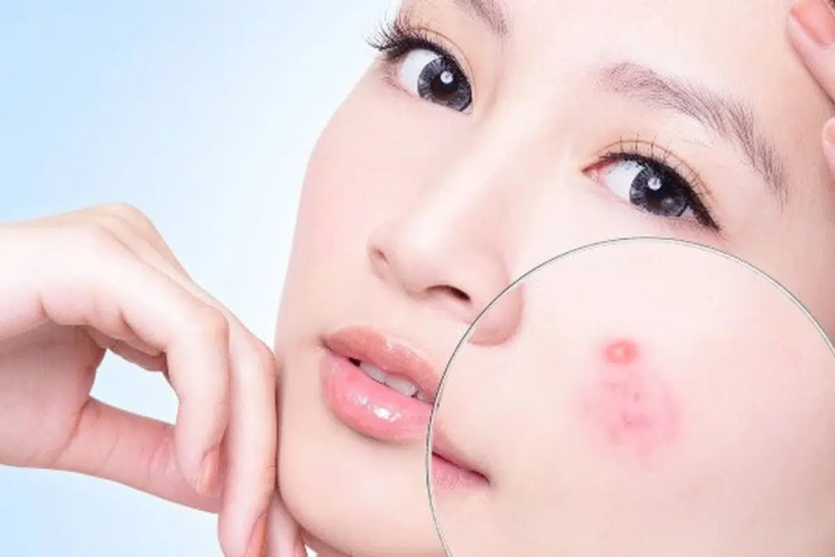 Bị mụn trứng cá không nên uống Collagen