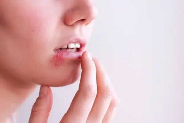 herpes simplex