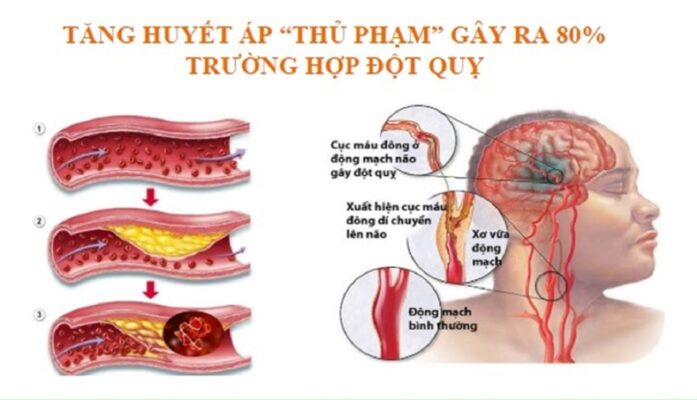 Ảnh minh họa nguyên nhân chính gây nên đột quỵ