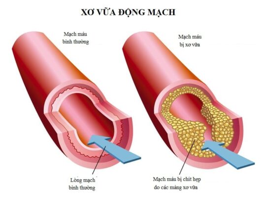 Ảnh minh họa xơ vữa động mạch