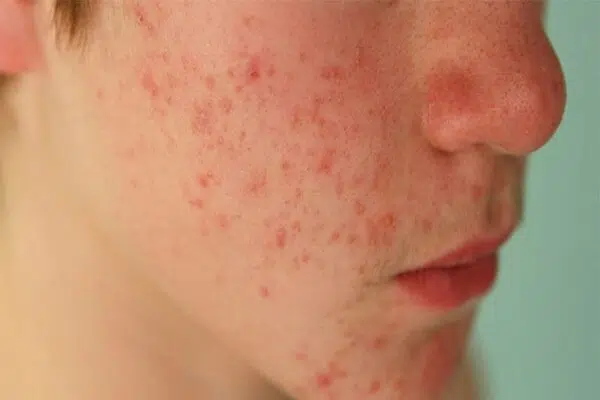 Nhược điểm collagen type II